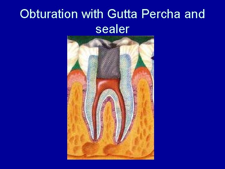 Obturation with Gutta Percha and sealer 