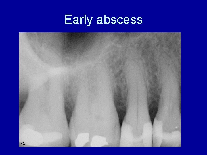 Early abscess 