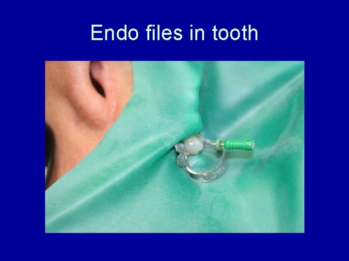Endo files in tooth 
