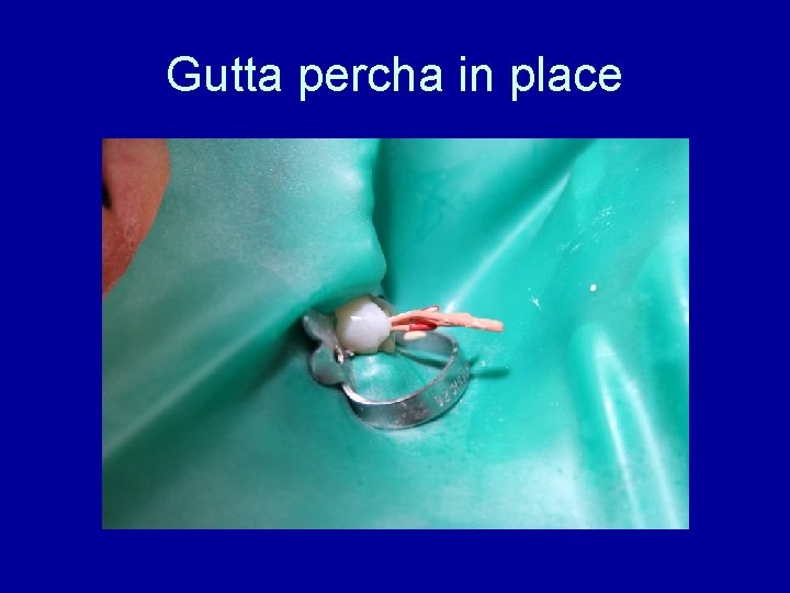 Gutta percha in place 
