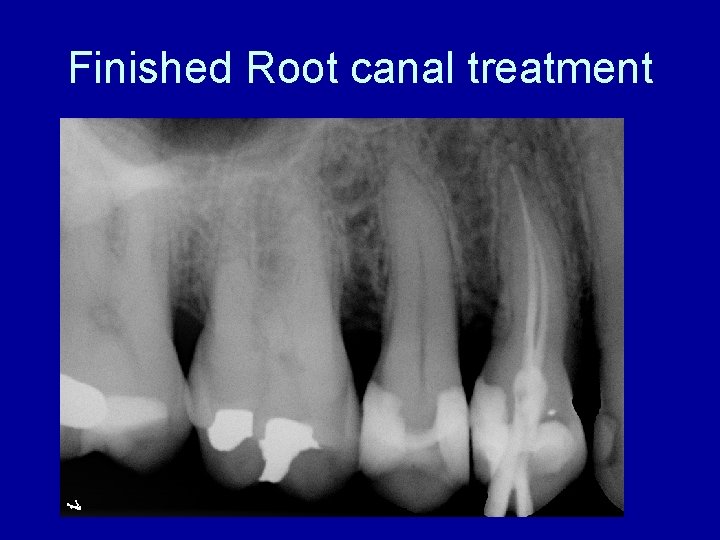 Finished Root canal treatment 