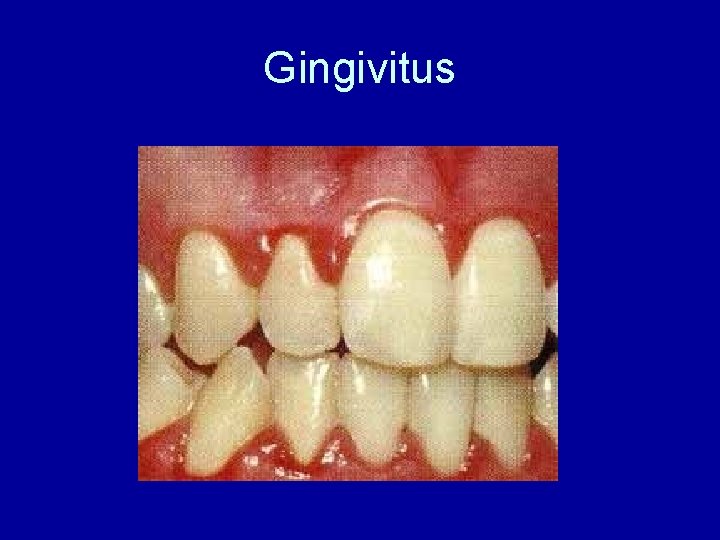 Gingivitus 
