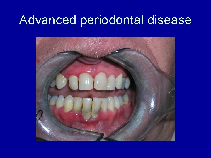 Advanced periodontal disease 