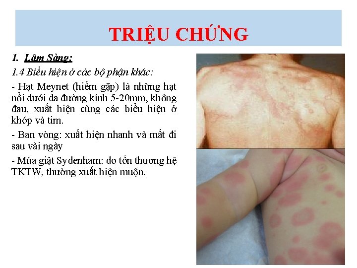 TRIỆU CHỨNG 1. Lâm Sàng: 1. 4 Biểu hiện ở các bộ phận khác: