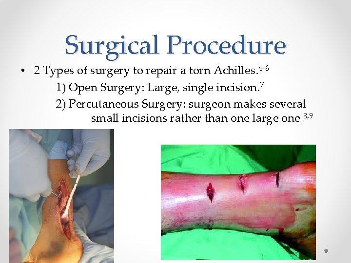 Surgical Procedure • 2 Types of surgery to repair a torn Achilles. 4 -6