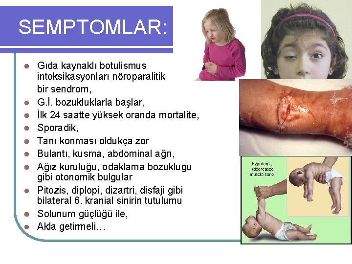 SEMPTOMLAR: l l l l l Gıda kaynaklı botulismus intoksikasyonları nöroparalitik bir sendrom, G.