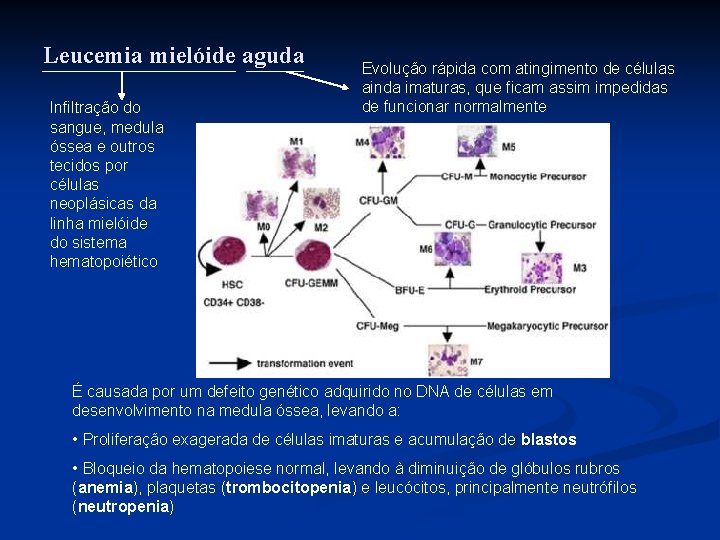 Leucemia mielóide aguda Infiltração do sangue, medula óssea e outros tecidos por células neoplásicas