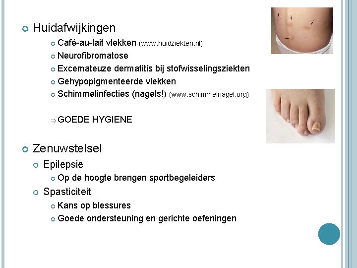  Huidafwijkingen Café-au-lait vlekken (www. huidziekten. nl) Neurofibromatose Excemateuze dermatitis bij stofwisselingsziekten Gehypopigmenteerde vlekken