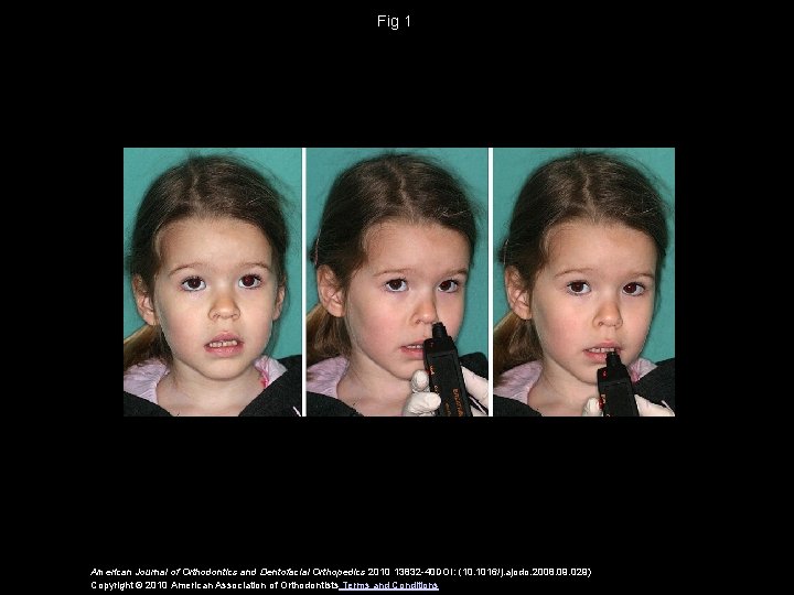 Fig 1 American Journal of Orthodontics and Dentofacial Orthopedics 2010 13832 -40 DOI: (10.