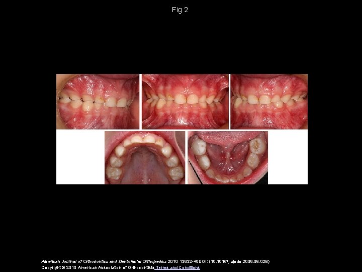 Fig 2 American Journal of Orthodontics and Dentofacial Orthopedics 2010 13832 -40 DOI: (10.