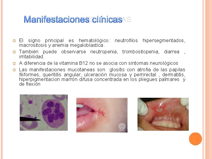 MANIFESTACIONES CLÍNICAS El signo principal es hematológico: neutrofilos hipersegmentados, macrositosis y anemia megaloblastica. También