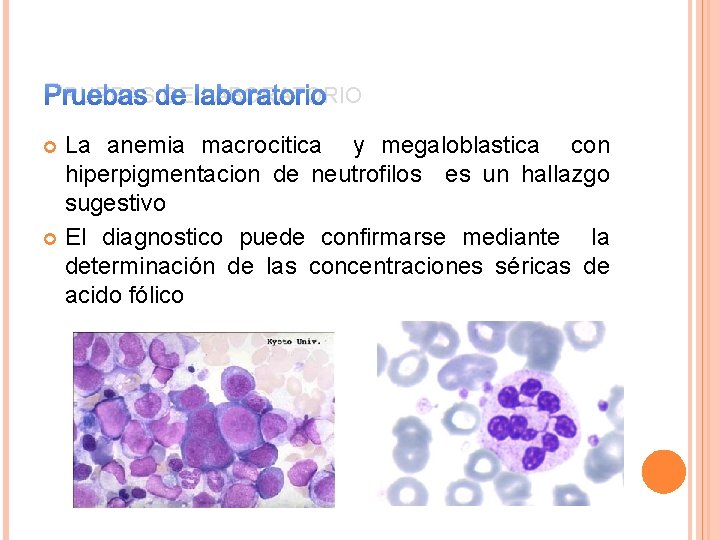 PRUEBAS DE LABORATORIO La anemia macrocitica y megaloblastica con hiperpigmentacion de neutrofilos es un