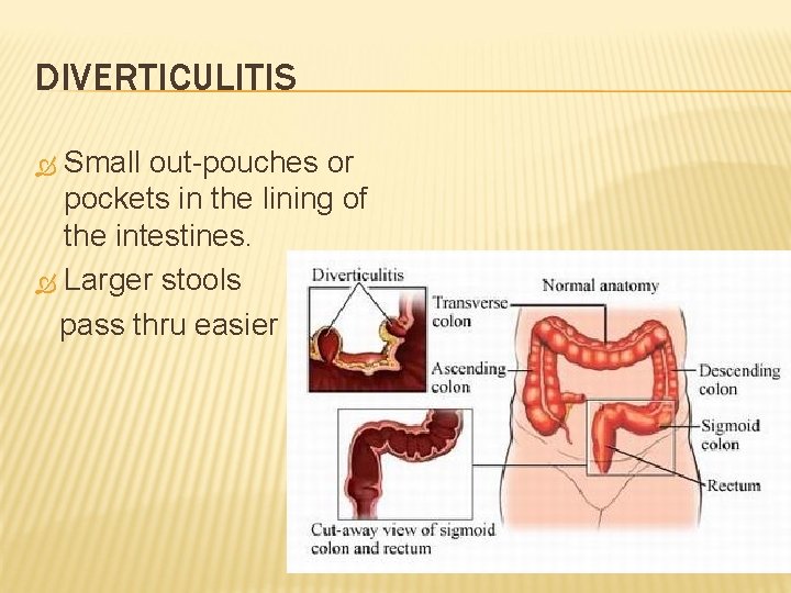 DIVERTICULITIS Small out-pouches or pockets in the lining of the intestines. Larger stools pass
