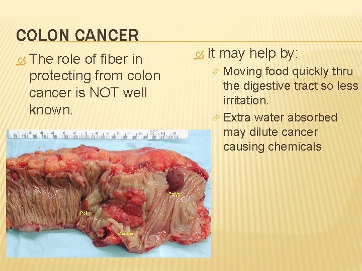 COLON CANCER The role of fiber in protecting from colon cancer is NOT well