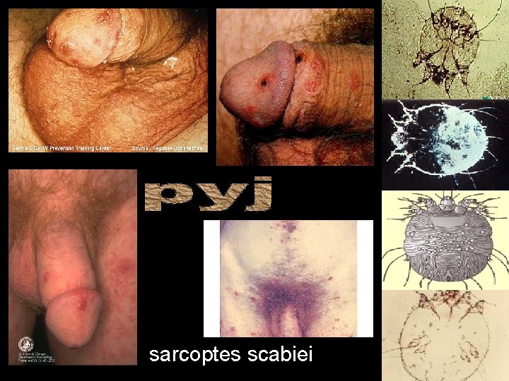 sarcoptes scabiei 