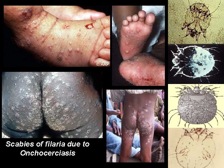 Scabies of filaria due to Onchocerciasis 
