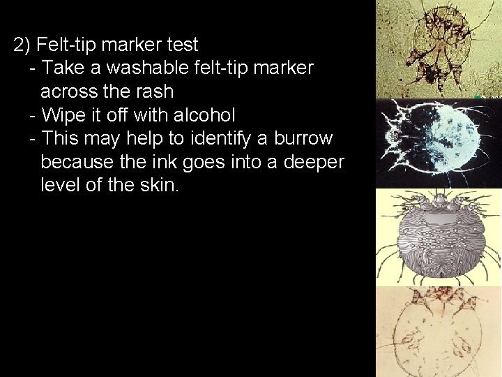 2) Felt-tip marker test - Take a washable felt-tip marker across the rash -
