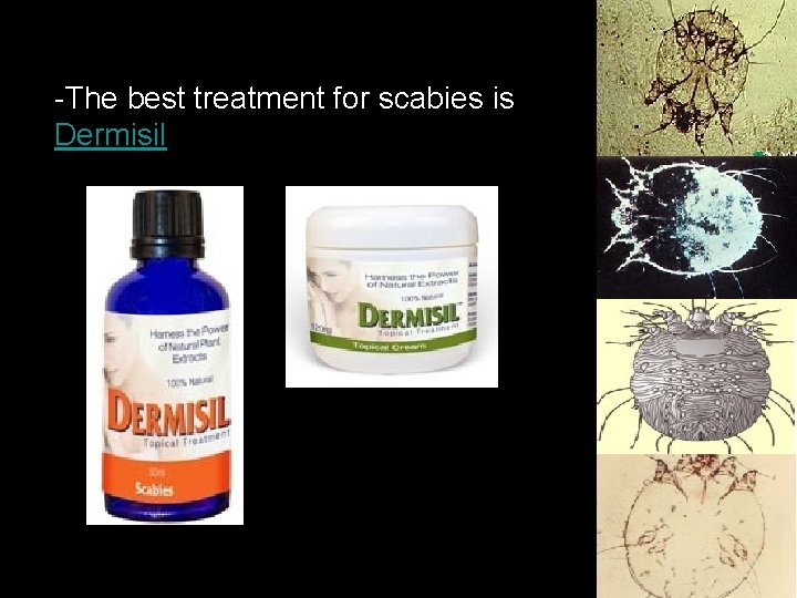 -The best treatment for scabies is Dermisil 