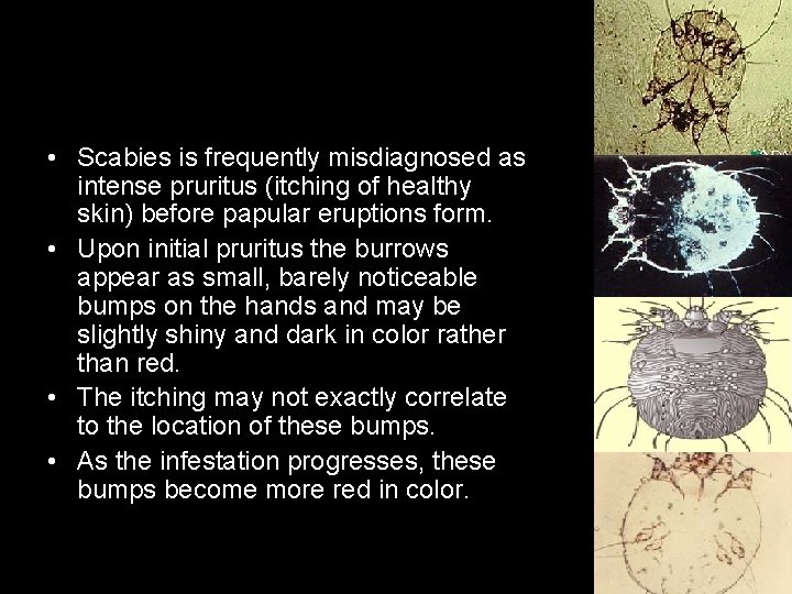  • Scabies is frequently misdiagnosed as intense pruritus (itching of healthy skin) before