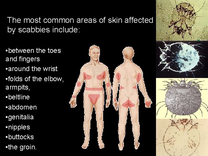 The most common areas of skin affected by scabbies include: • between the toes