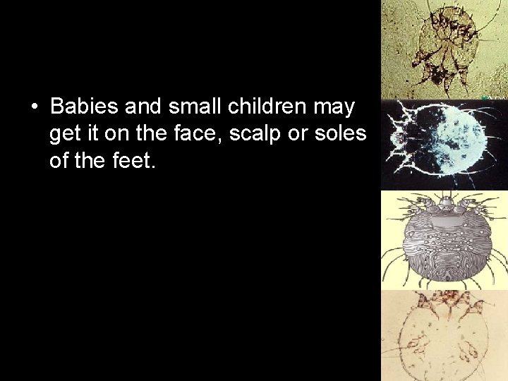  • Babies and small children may get it on the face, scalp or