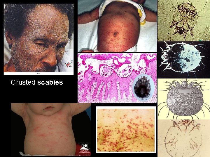 Crusted scabies 