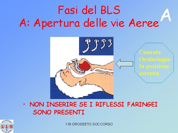 Fasi del BLS A: Apertura delle vie Aeree A Cannula Orofaringea In posizione corretta