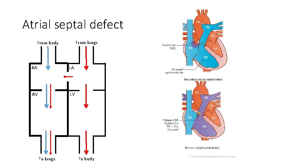 Atrial septal defect From lungs From body RA LA RV LV To lungs To