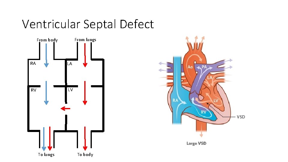 Ventricular Septal Defect From lungs From body RA LA RV LV To lungs To