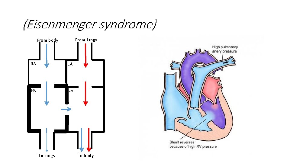 (Eisenmenger syndrome) From lungs From body RA LA RV LV To lungs To body