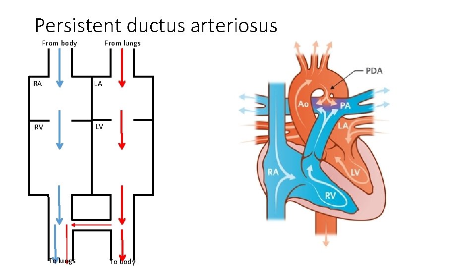 Persistent ductus arteriosus From body From lungs RA LA RV LV To lungs To