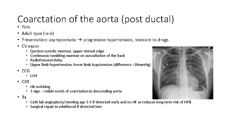 Coarctation of the aorta (post ductal) • • Pink Adult type (rare) Presentation: asymptomatic