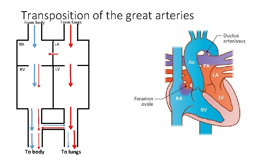 Transposition of the great arteries From lungs From body RA LA RV LV To
