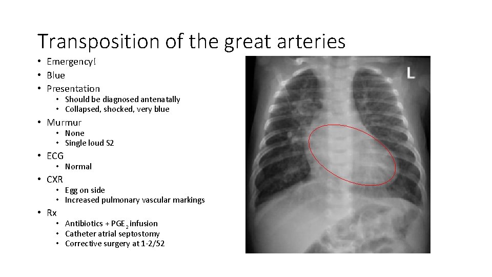 Transposition of the great arteries • Emergency! • Blue • Presentation • Should be