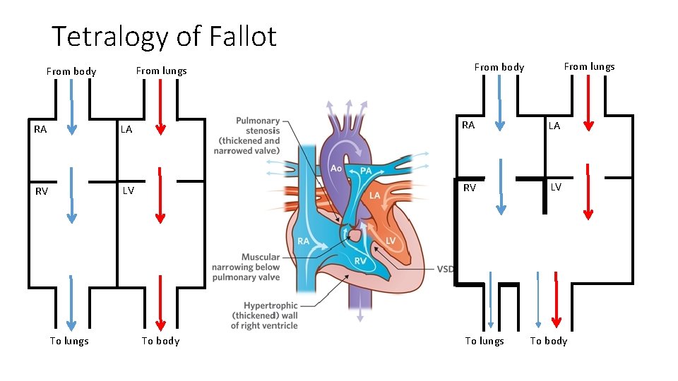 Tetralogy of Fallot From lungs From body RA LA RV LV To lungs To