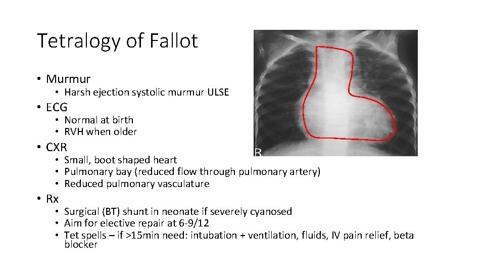 Tetralogy of Fallot • Murmur • Harsh ejection systolic murmur ULSE • ECG •