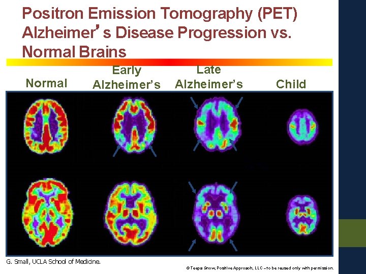 Positron Emission Tomography (PET) Alzheimer’s Disease Progression vs. Normal Brains Normal Early Alzheimer’s Late