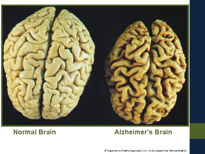 Normal Brain Alzheimer’s Brain Alzheimers Brain © Teepa Snow, Positive Approach, LLC – to