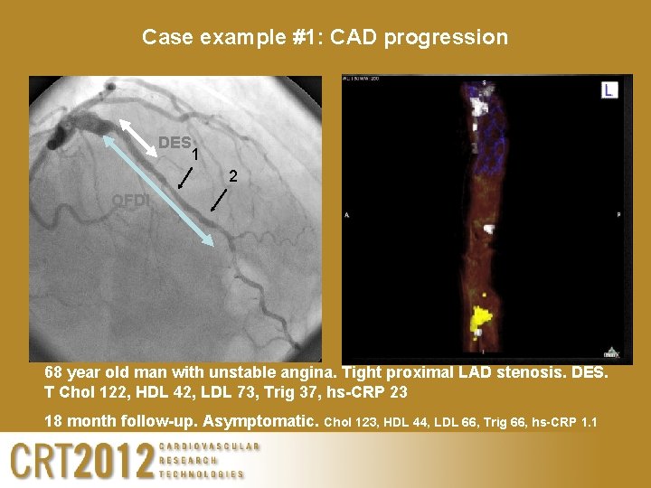 Case example #1: CAD progression DES 1 1 2 2 OFDI 68 year old