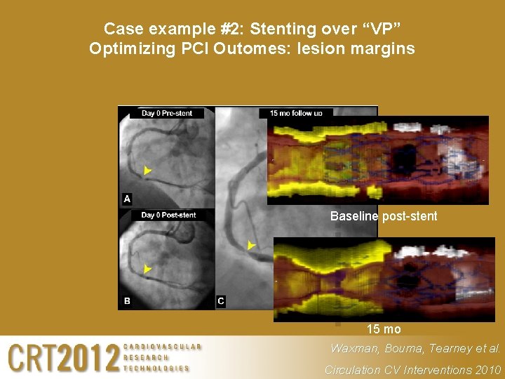 Case example #2: Stenting over “VP” Optimizing PCI Outomes: lesion margins Baseline post-stent 15