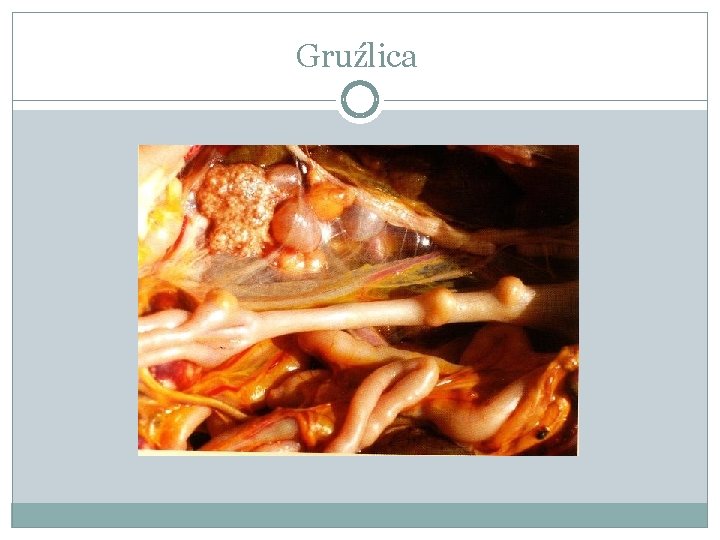 Gruźlica 