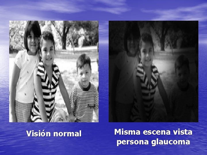 Visión normal Misma escena vista persona glaucoma 