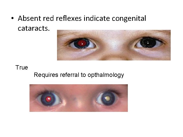  • Absent red reflexes indicate congenital cataracts. True Requires referral to opthalmology 