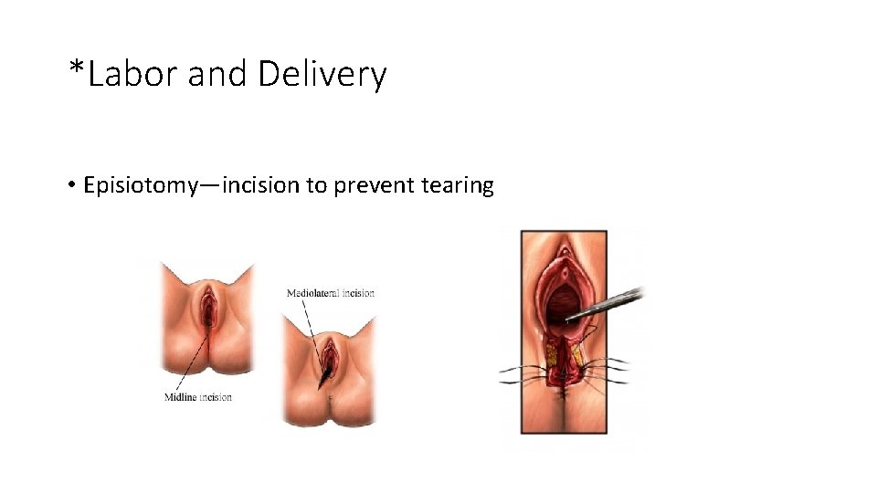 *Labor and Delivery • Episiotomy—incision to prevent tearing 
