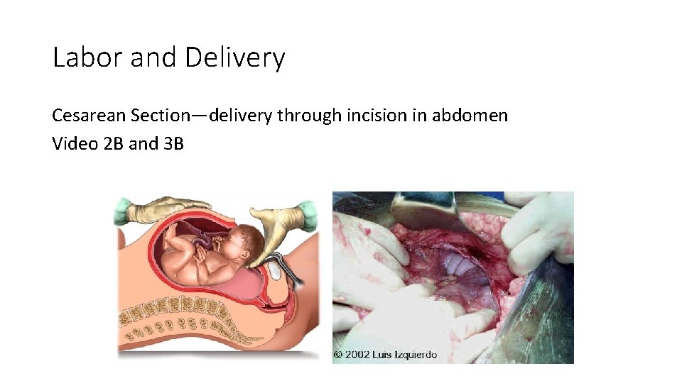 Labor and Delivery Cesarean Section—delivery through incision in abdomen Video 2 B and 3