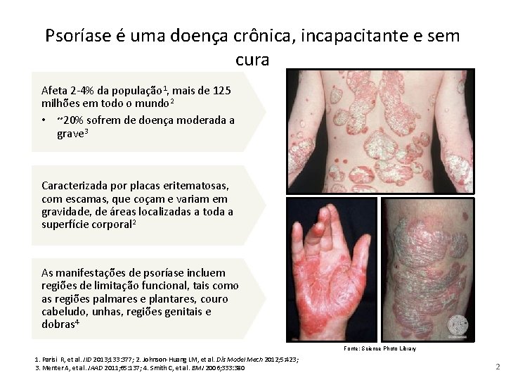 Psoríase é uma doença crônica, incapacitante e sem cura Afeta 2 -4% da população