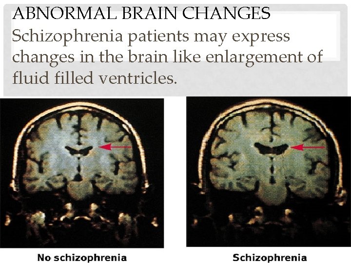ABNORMAL BRAIN CHANGES Schizophrenia patients may express changes in the brain like enlargement of