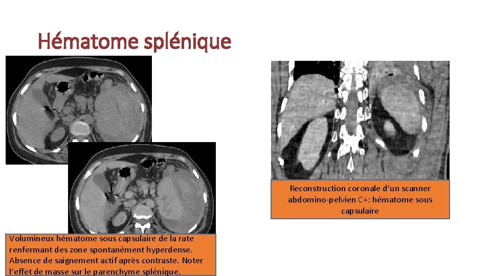 Hématome splénique Reconstruction coronale d’un scanner abdomino-pelvien C+: hématome sous capsulaire Volumineux hématome sous