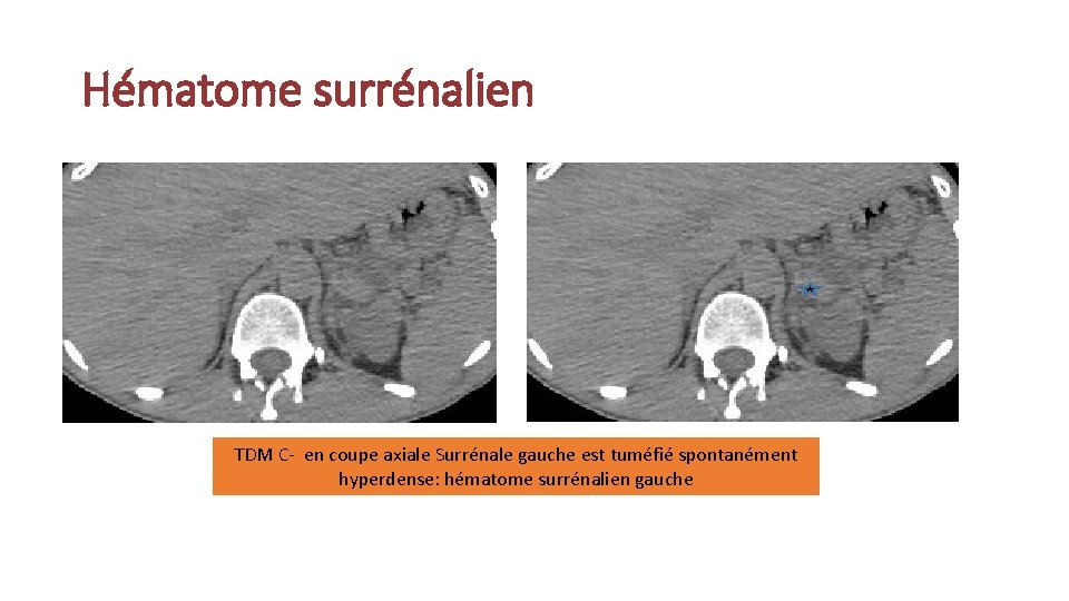 Hématome surrénalien TDM C- en coupe axiale Surrénale gauche est tuméfié spontanément hyperdense: hématome