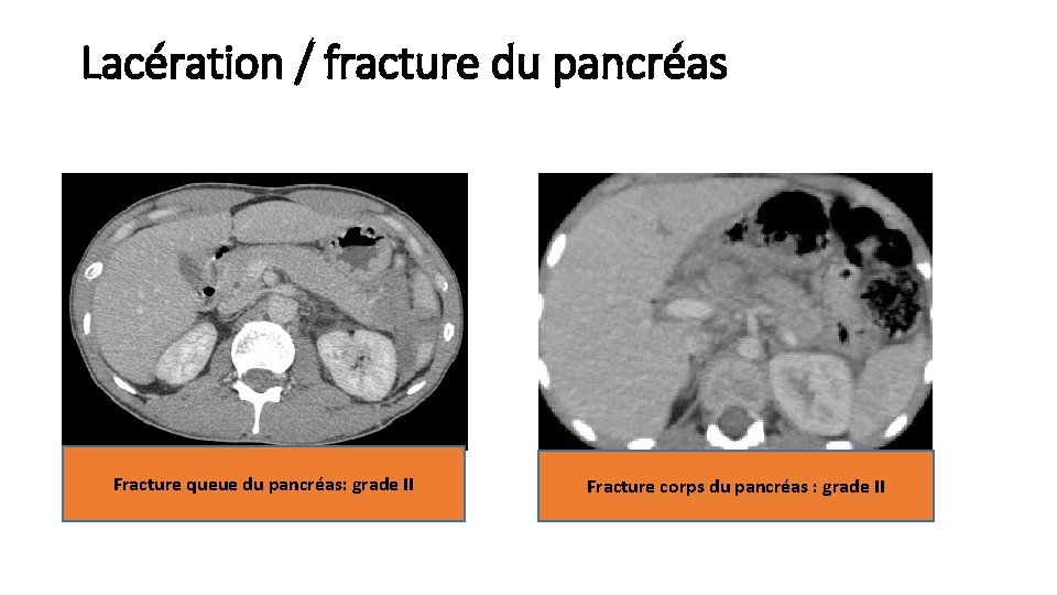 Lacération / fracture du pancréas Fracture queue du pancréas: grade II Fracture corps du